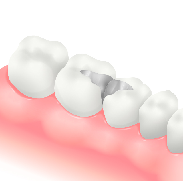メタルインレー(銀色の金属素材)