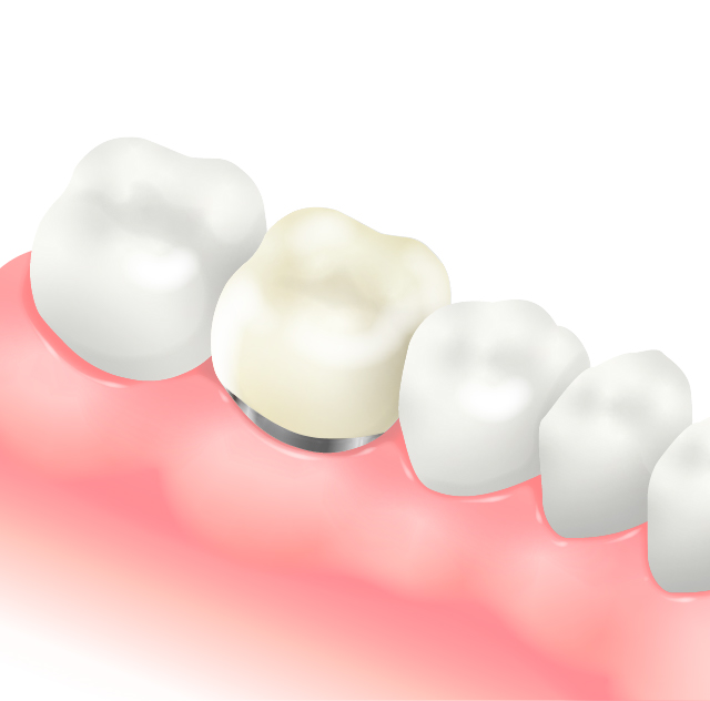 オールセラミッククラウン