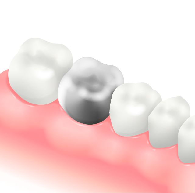 硬質レジン前装冠(前歯のみ)