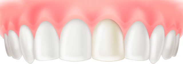 硬質レジン前装冠(前歯のみ)